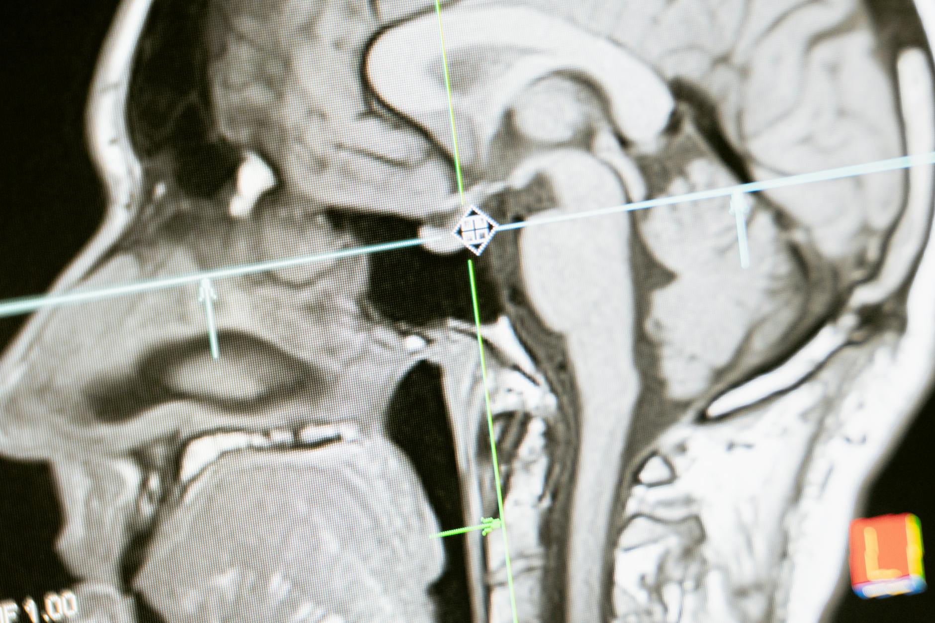 The Intersection of Brain Fog and Chronic Illness: Causes, Symptoms, and Management